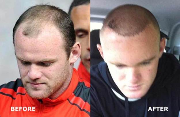 wayne-rooney-before-and-after-hair-transplant